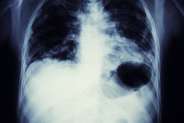 Lung Cancer X-Ray