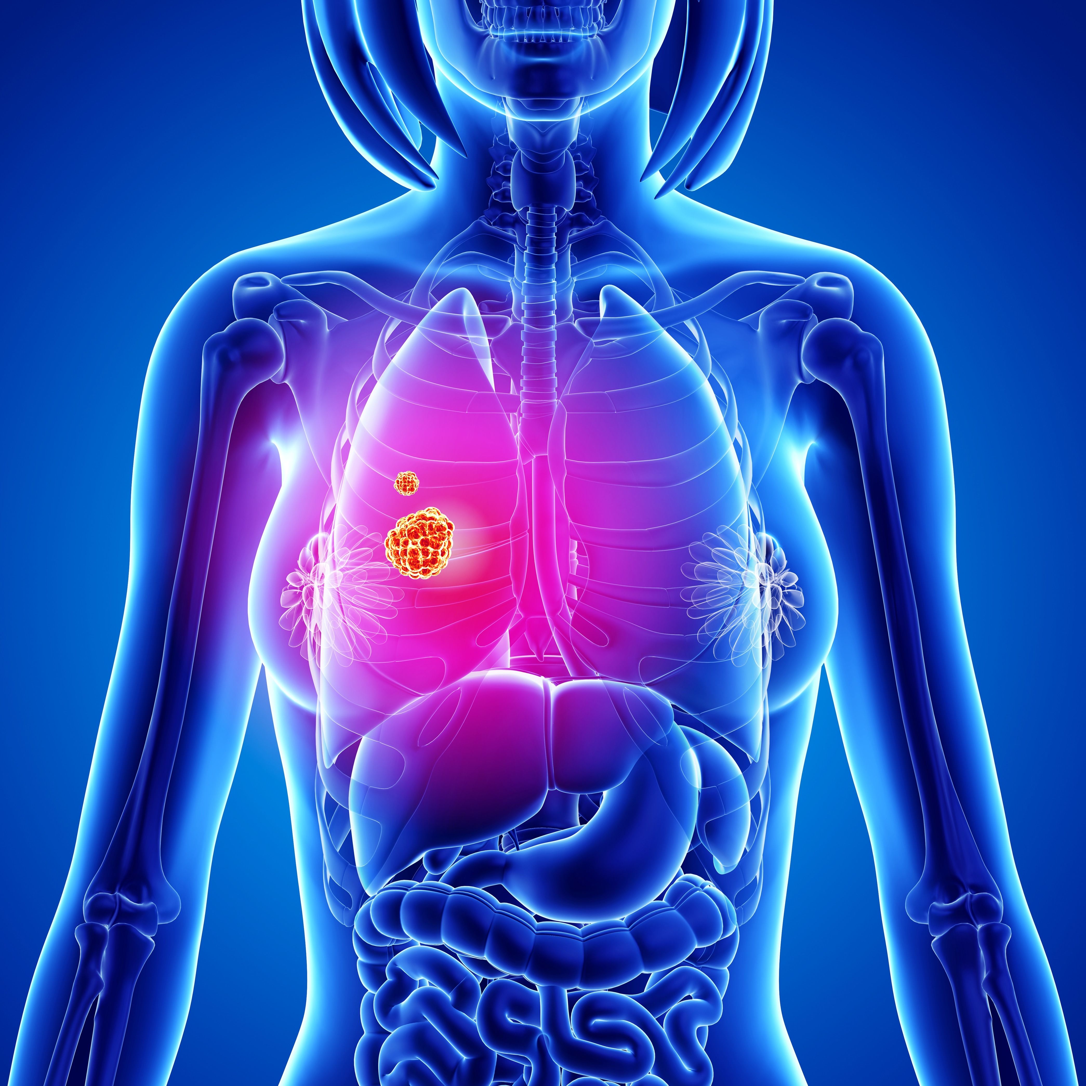 Lung Neoplasms 