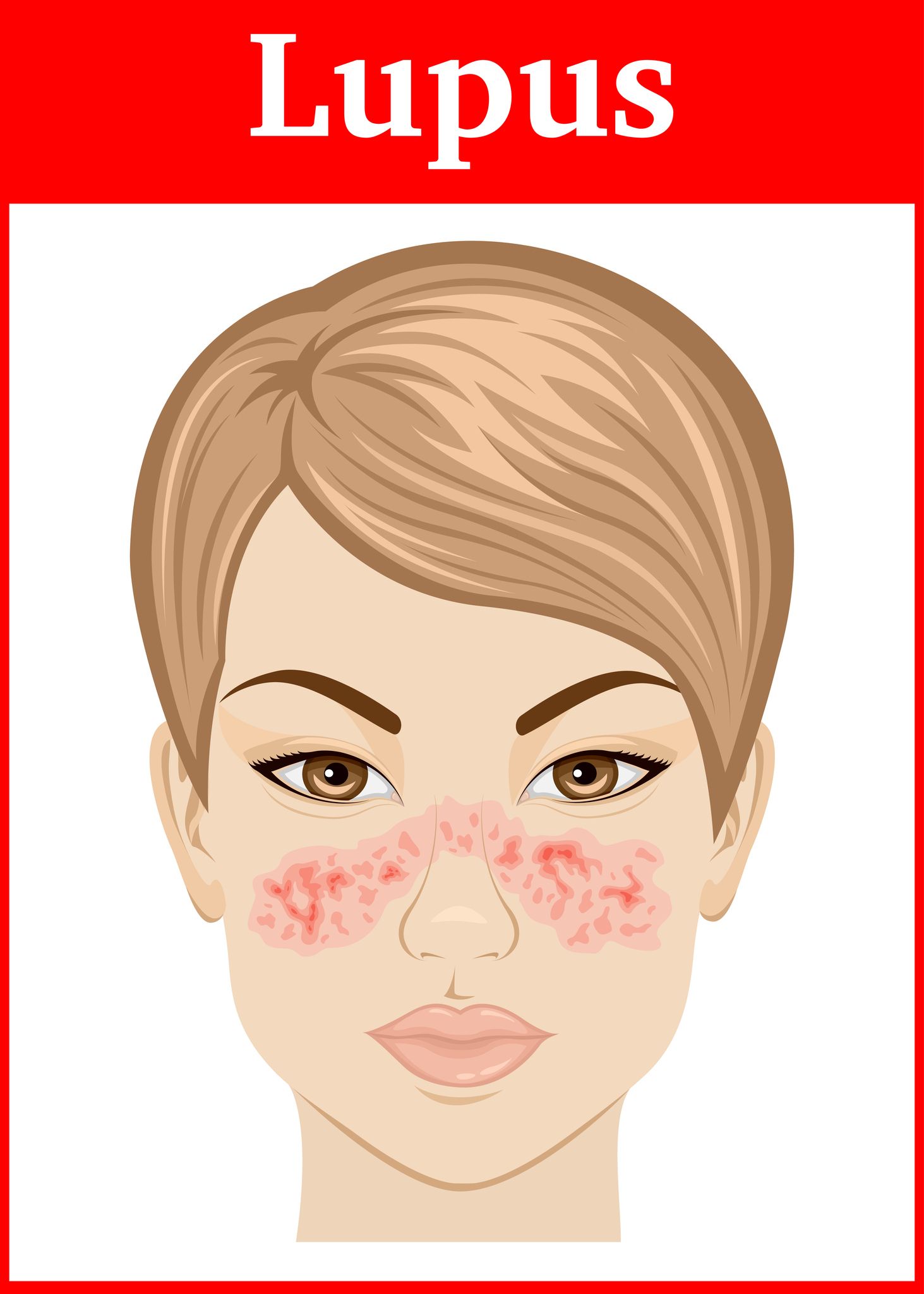 A butterfly-shaped rash that appears on both cheeks and across the bridge of the nose is highly suggestive of lupus.