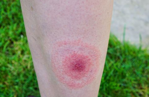 lyme disease, borreliosis or borrelia, typical lyme rash, spot