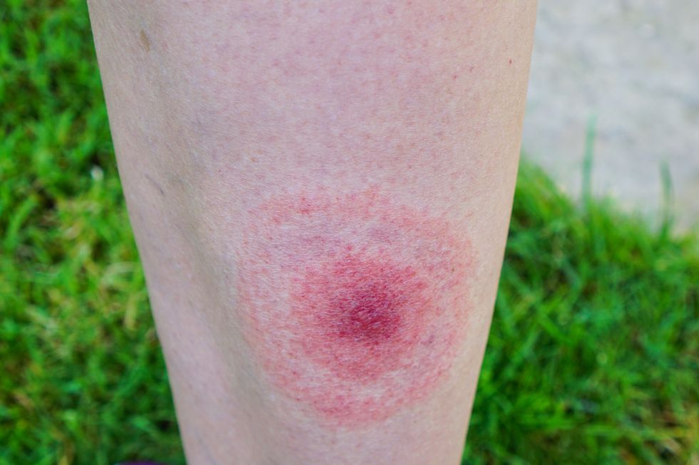 Lyme disease, Borreliosis or Borrelia, typical lyme rash, spot.