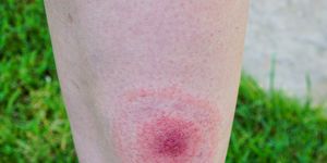 Lyme disease, Borreliosis or Borrelia, typical lyme rash, spot.