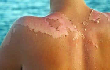 sunburn
