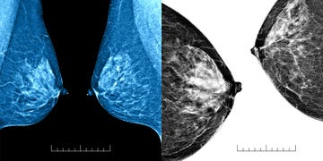 mammography