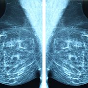 mammogram radio imagingr breast cancer diagnosis