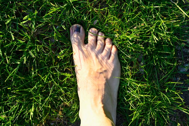 A man has a wound toe because wearing small shoes. The foot is on a floor with grass.