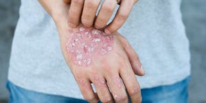 psoriasis types pictures