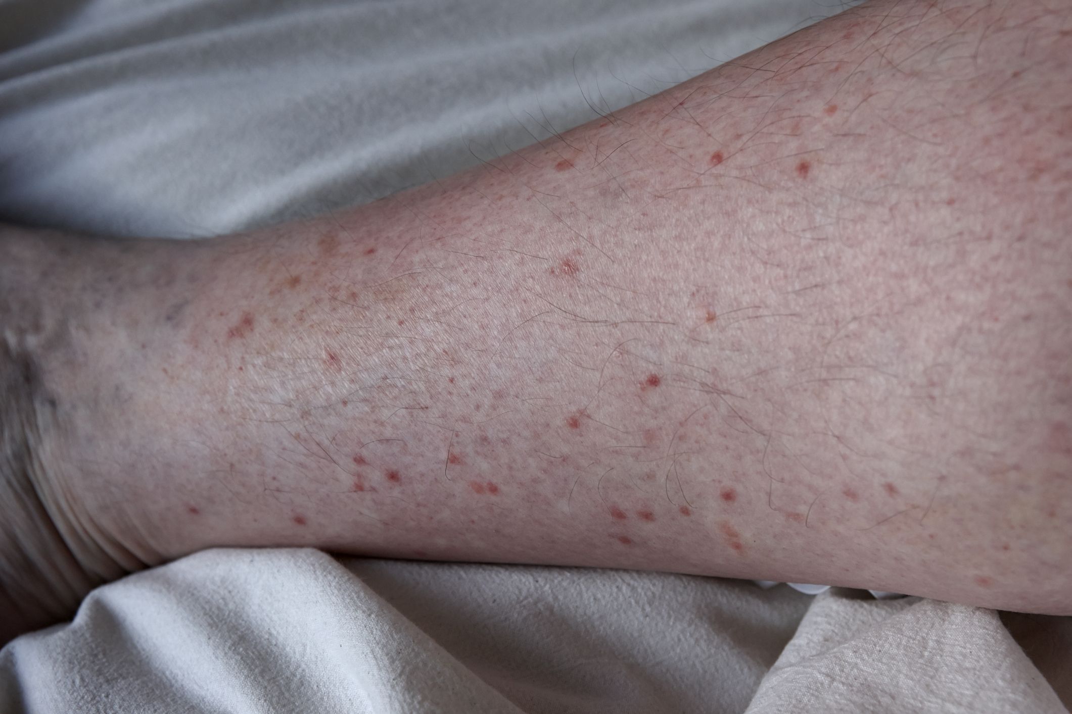 Little Red Dots On Skin Bug Bites