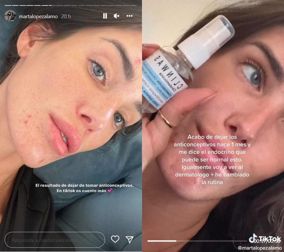 la novia de kiko matamoros enseña su cara con granitos tras dejar los anticonceptivos