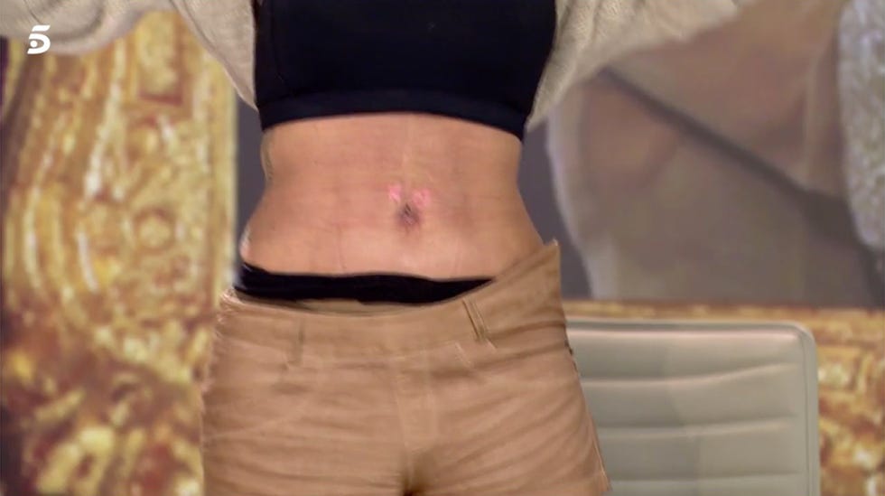 marat lópez enseña en 'ya es mediodía' el resultado de sus operaciones abdominoplastia y operación de pecho