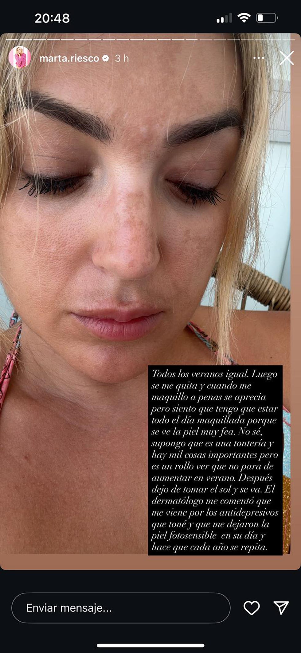 marta riesco habla de su problema en la piel