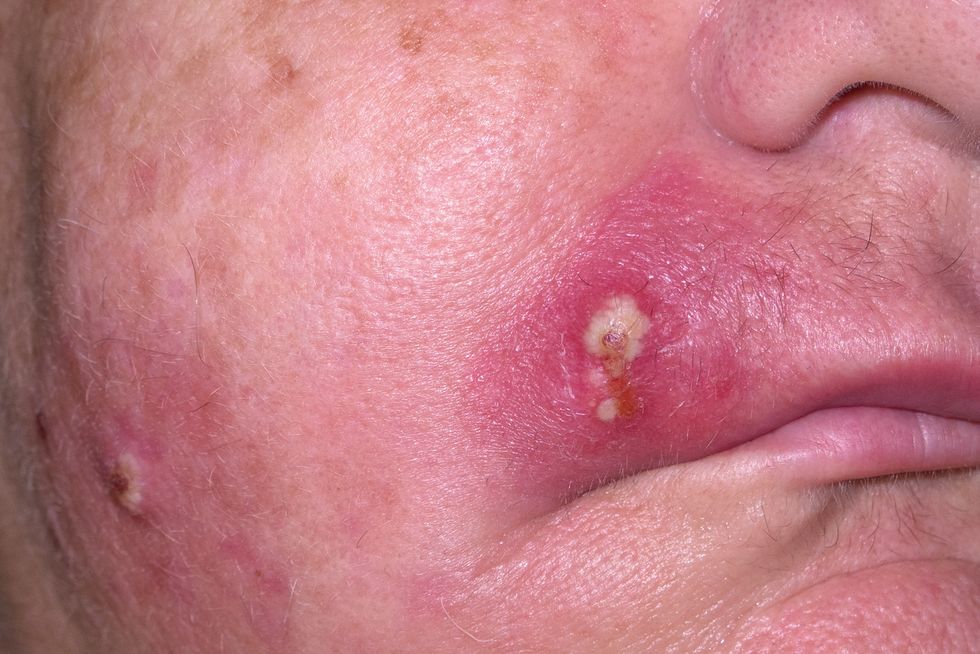 Pustules on the back possibly triggering toxic-shock syndrome