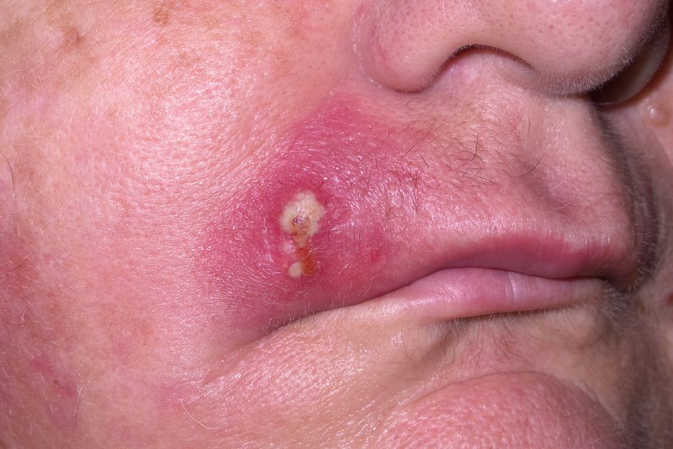 Mature woman with staph infection on face 4