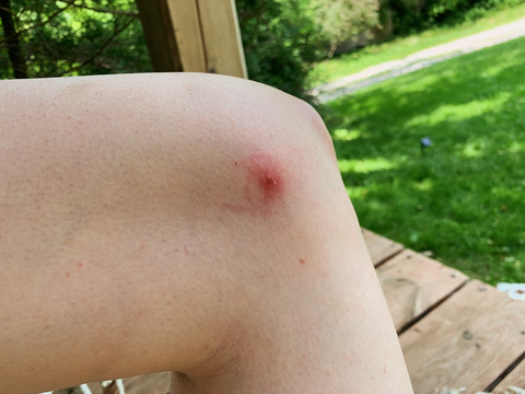 alpha gal syndrome, tick bite meat allergy, lone star tick