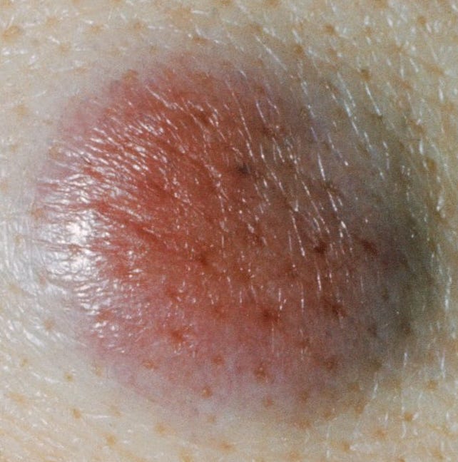 merkel cell carcinoma