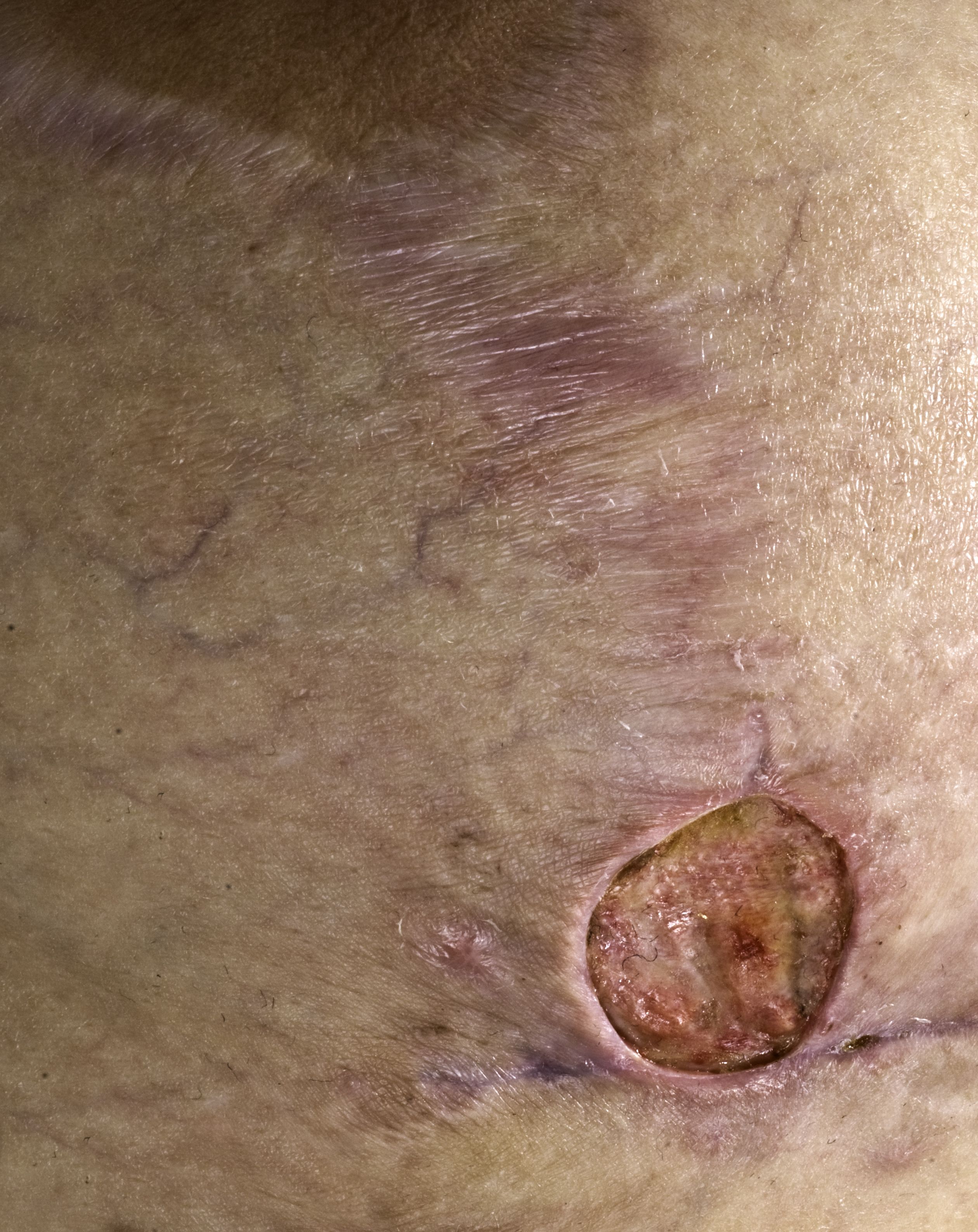 Is That A Brown Recluse Spider Bite Or Skin Cancer?