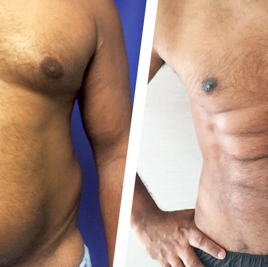 Plastic Surgeons Use Abdominal Etching to Create Six Pack