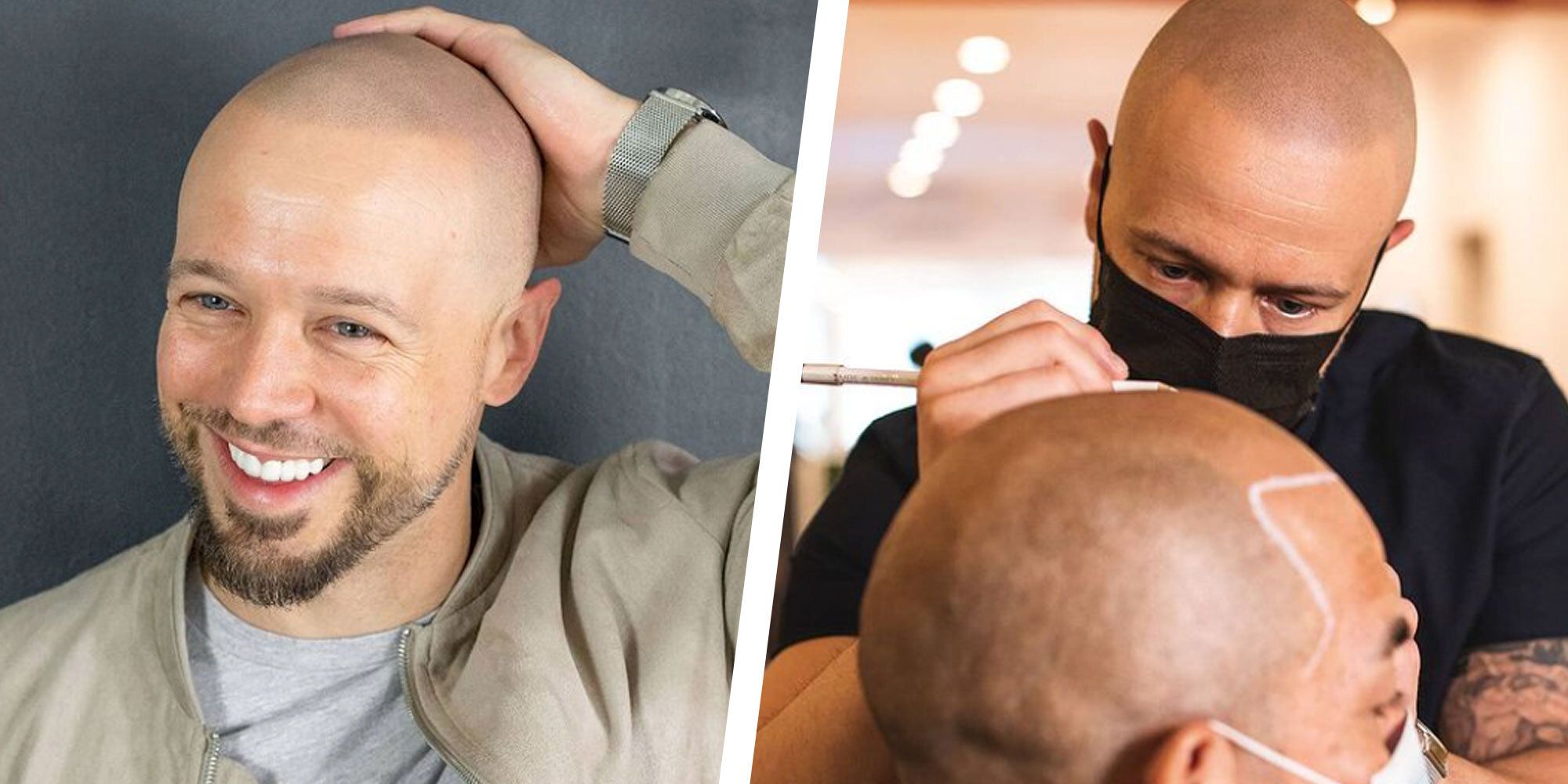 Scalp micropigmentation  SMP  Hair Tattoo Perth