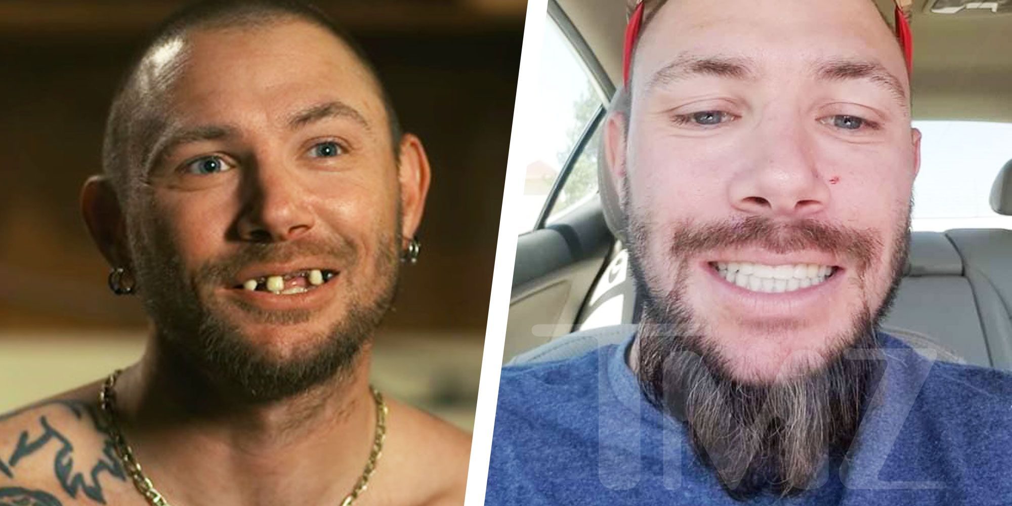 This Guy Fixed His Teeth by 3D-Printing His Own Plastic Braces For $60 :  ScienceAlert