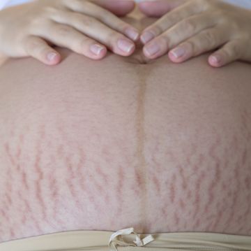 midsection of pregnant woman with stretch marks