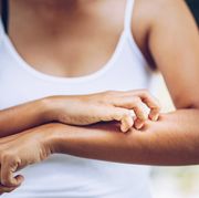 how to stop bug bites from itching, woman scratching arm