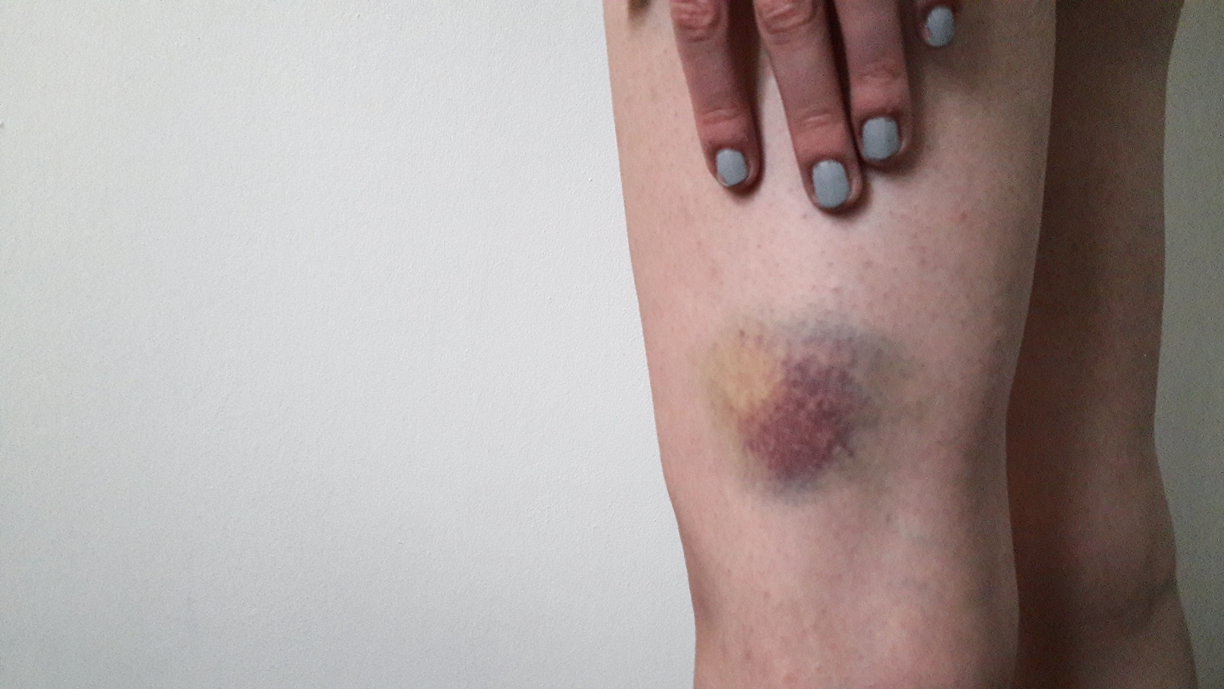 Midsection Of Woman With Bruised Leg Against Wall Royalty Free Image 1659108056 