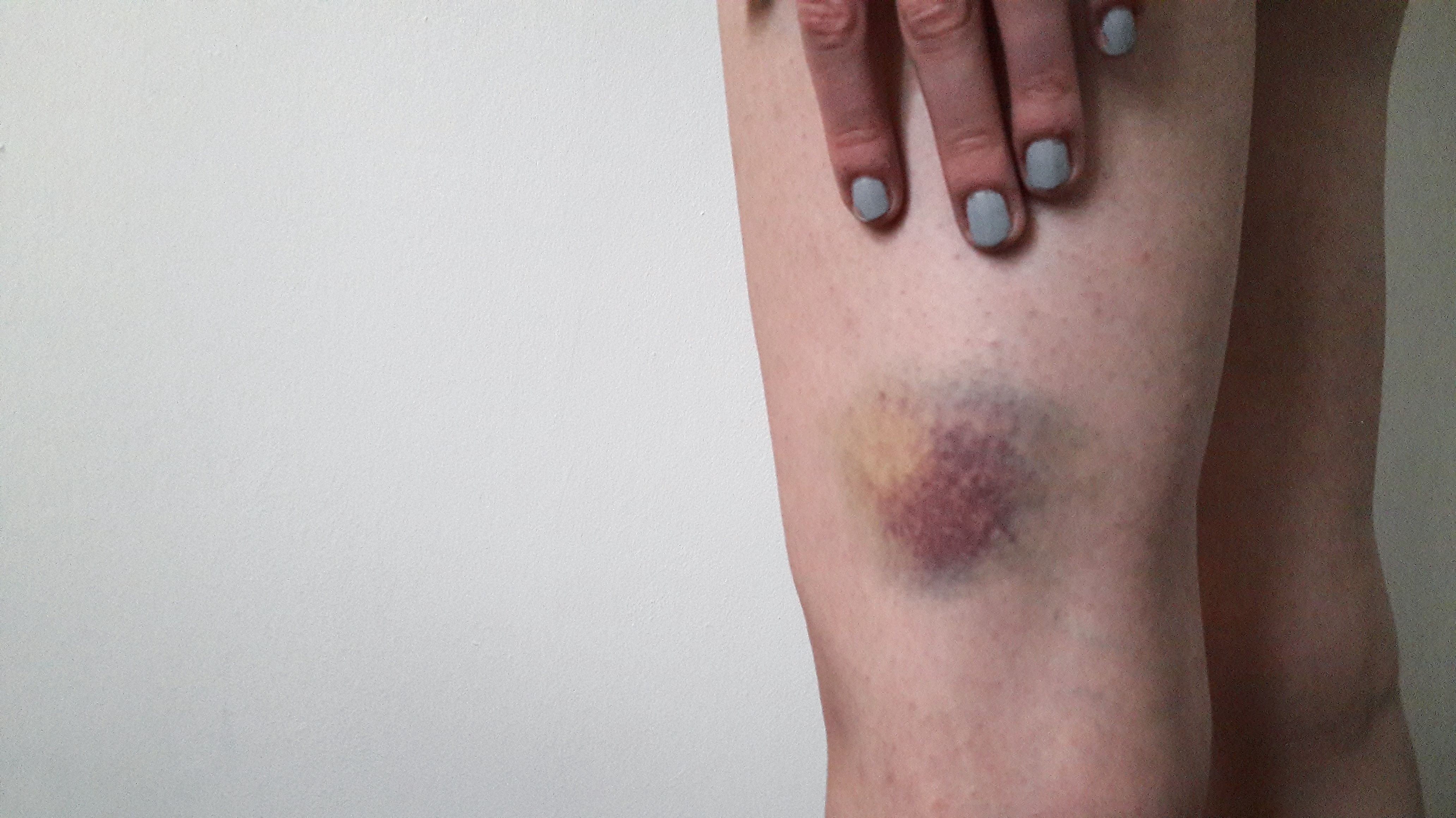 anemic bruise