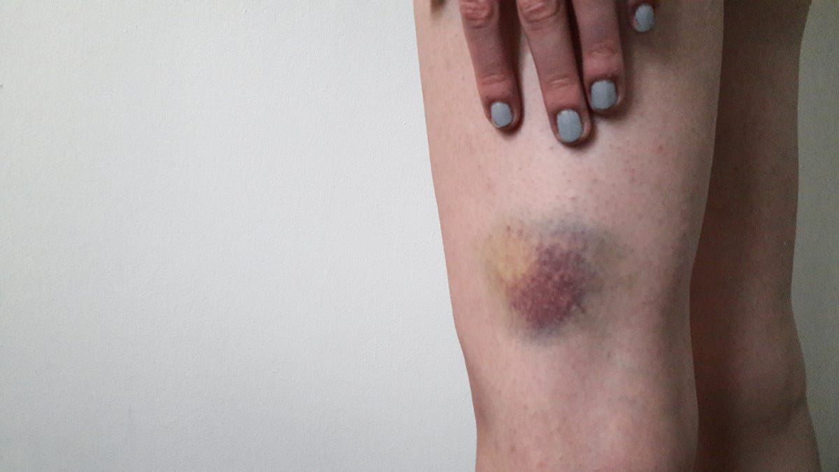 Why do i bruise easily doctors explain easy bruising