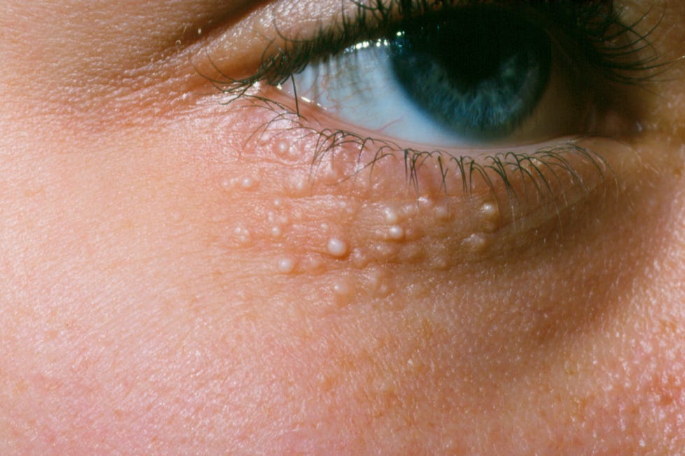 milia around eye