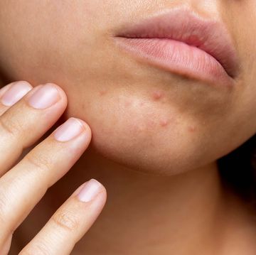 cropped shot of a young woman's face with the problem of acne pimples on the chin allergies, dermatitis, rash problem skin, care and beauty concept dermatology, cosmetology