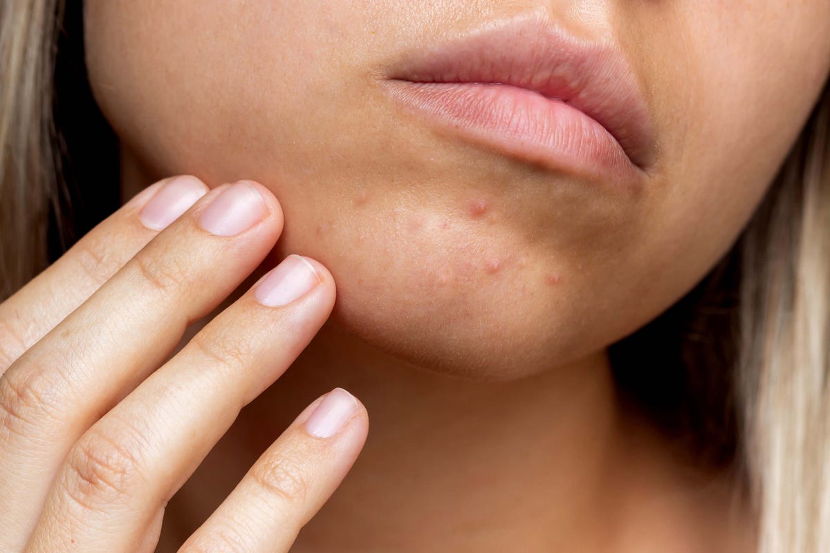 How To Get Rid Of Chin Acne, According To Dermatologists
