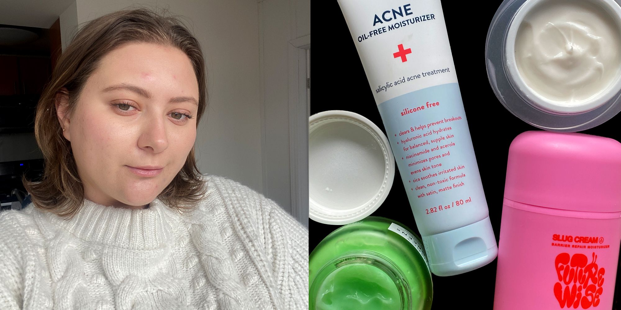 Moisturizers for Acne-Prone Skin