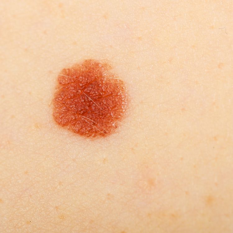 What does an early inflammatory breast cancer rash look like? | MD Anderson  Cancer Center