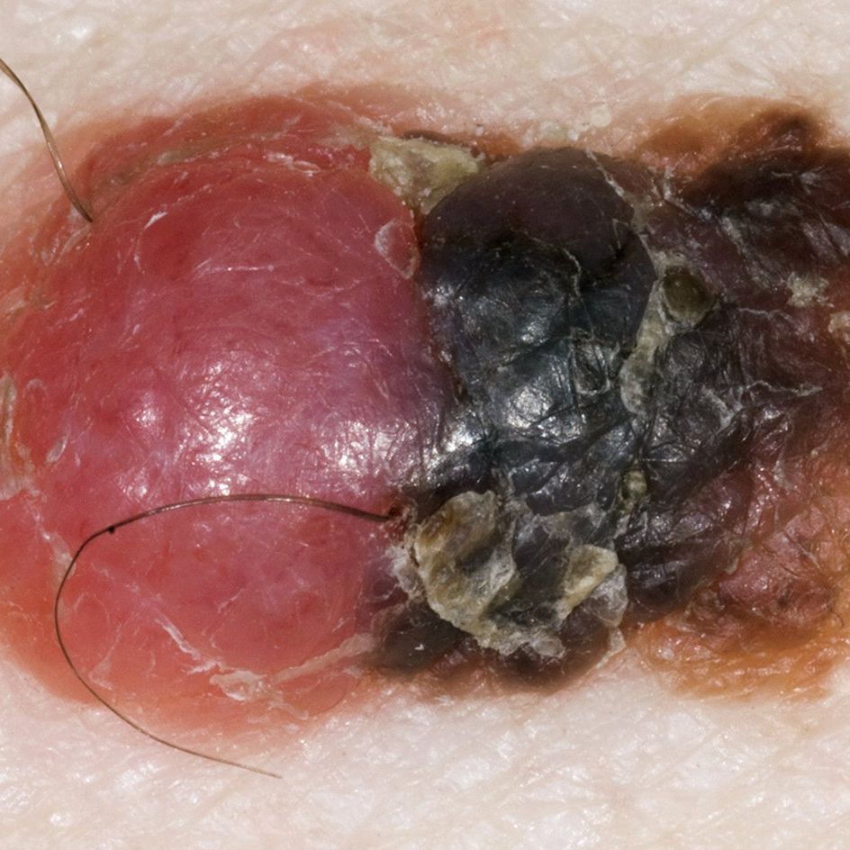 a swollen and sore crusting mole on skin