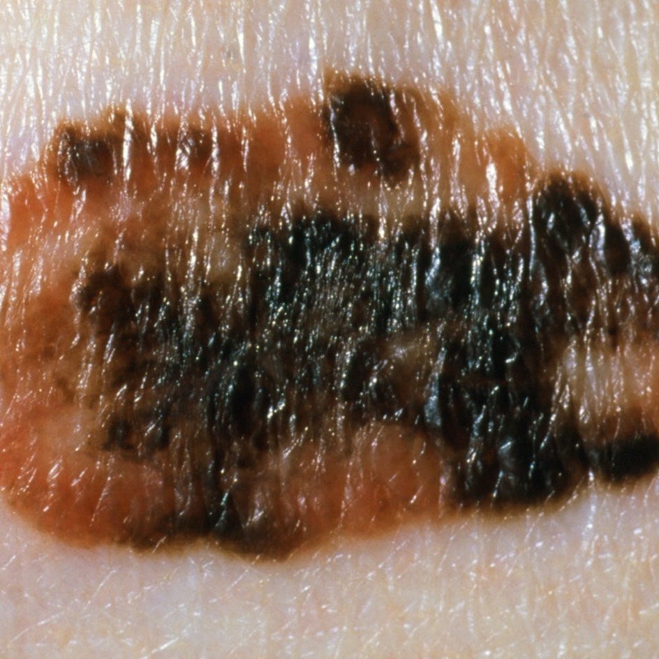 a mole on skin with a mix of colours
