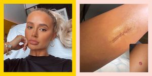 molly mae hague, mole, skin cancer, surgery