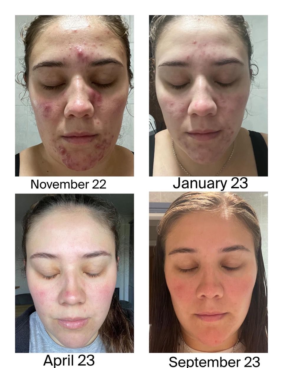 hormonal stress acne before and after