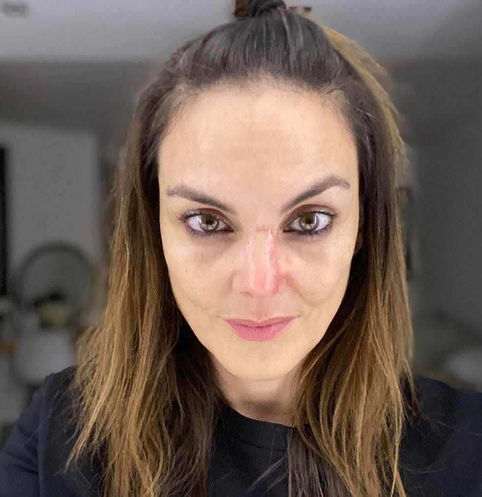 mónica carrillo confiesa su lucha contra el cáncer de piel