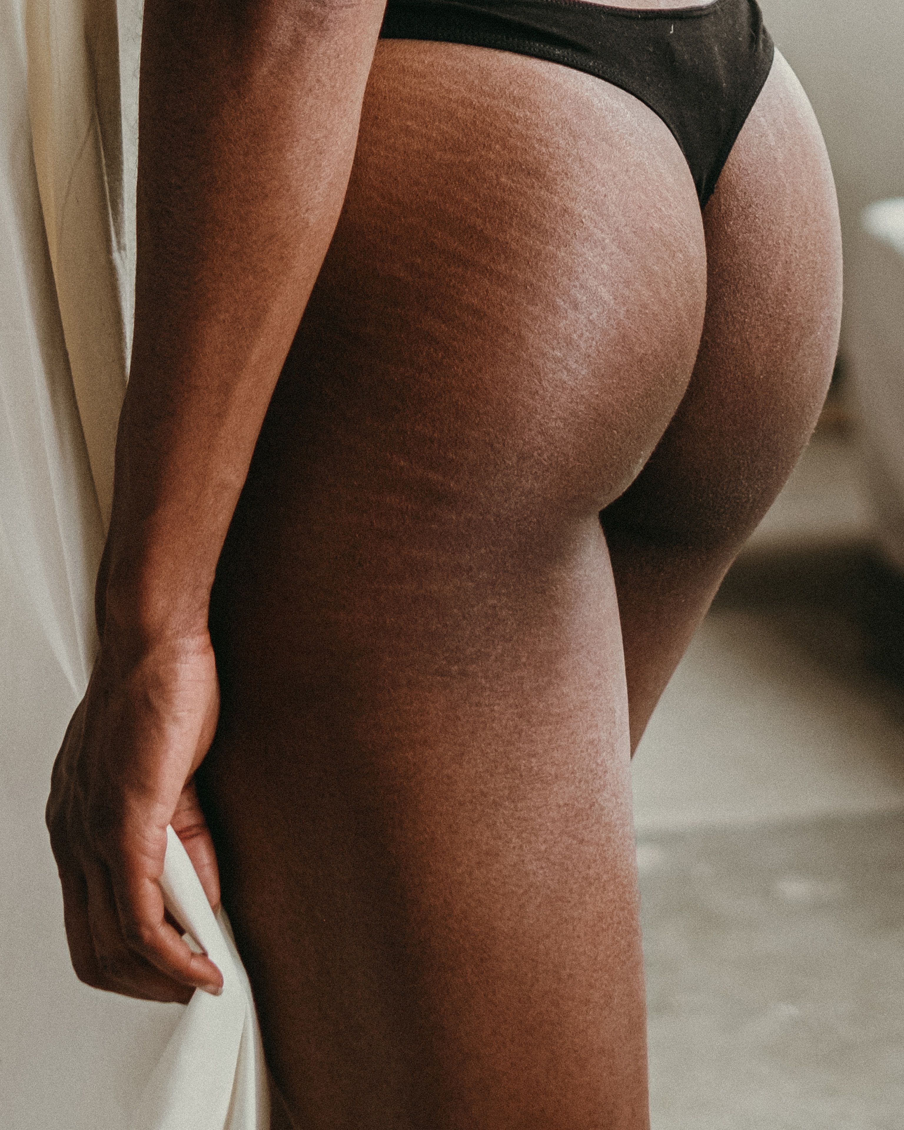 Do Stretch Marks From Puberty Go Away?