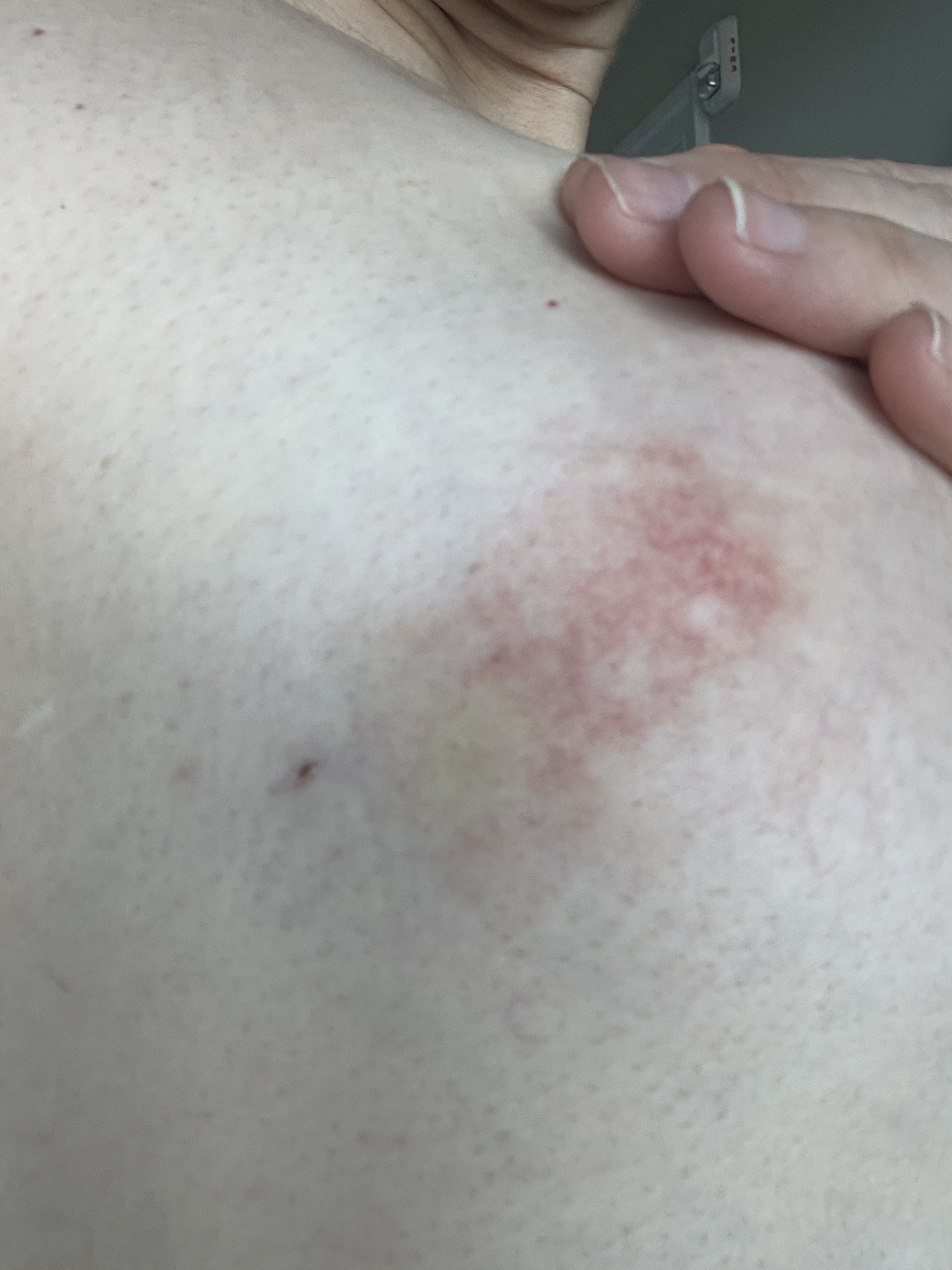 Small rash/ red irritation on side of breast that's toward middle