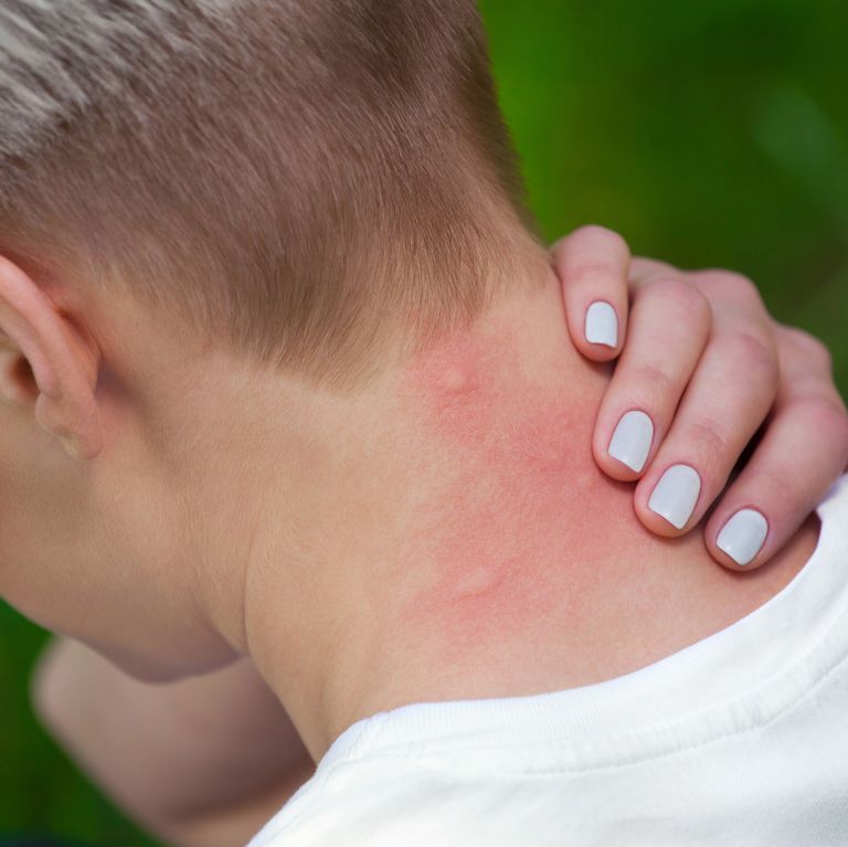 Mosquito Bite To The Neck Royalty Free Image 584572080 1558039675 