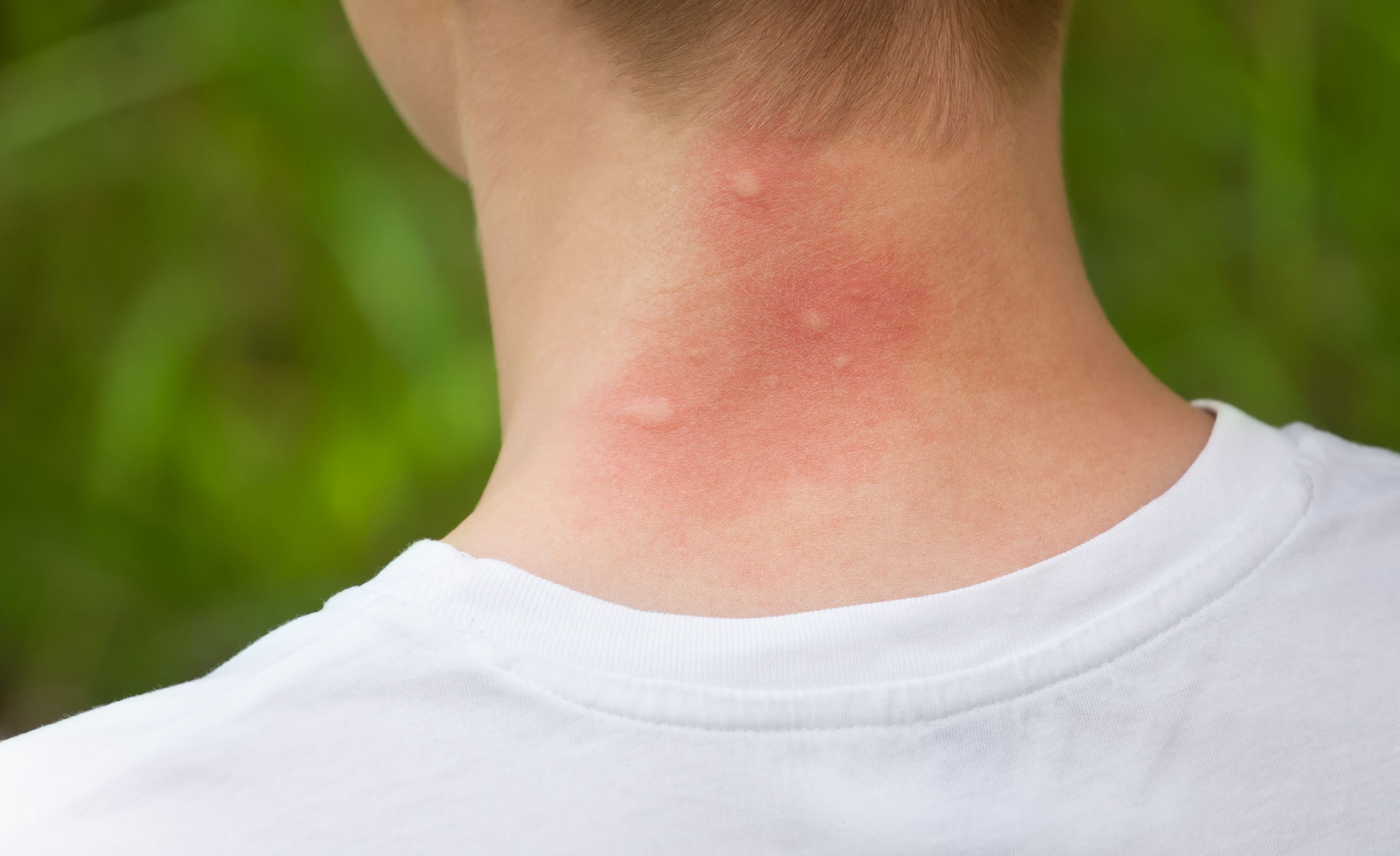Mosquito Bite Allergy Symptoms - Mosquito Bite Reaction Meaning