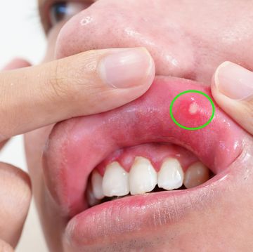 mouth ulcer sore or aphthous stomatitis oral health and medical concepts