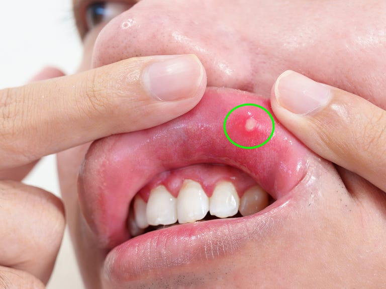 mouth ulcer sore or aphthous stomatitis oral health and medical concepts