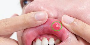 mouth ulcer sore or aphthous stomatitis oral health and medical concepts