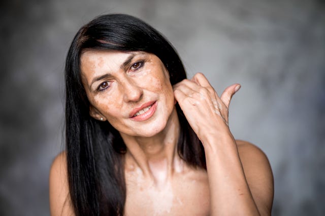 mujer morena con manchas en la piel