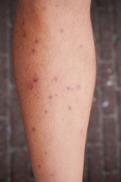 multiple bites of grass mites on a male leg