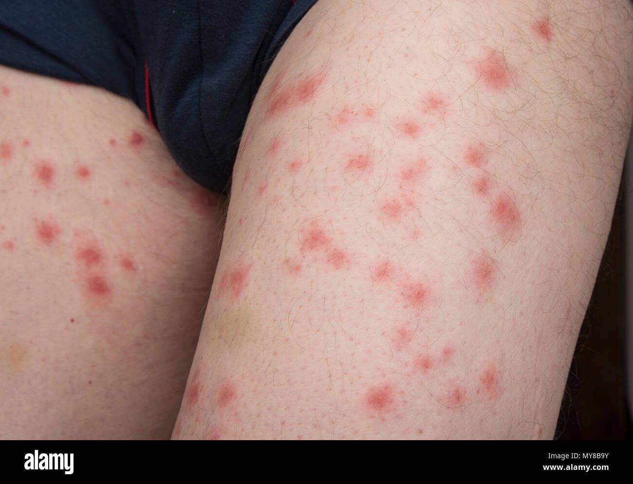 Skin rash on arms discount