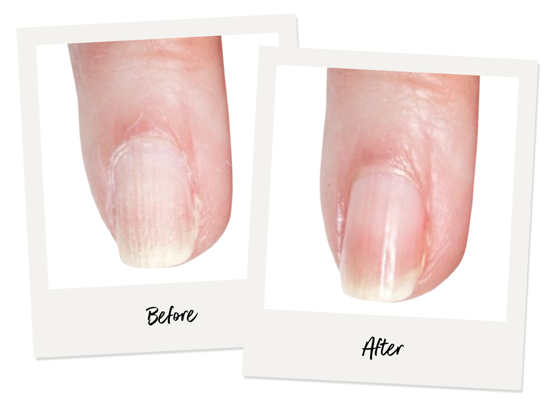 Nail Bed Injury - Surgical Repair - TeachMeSurgery