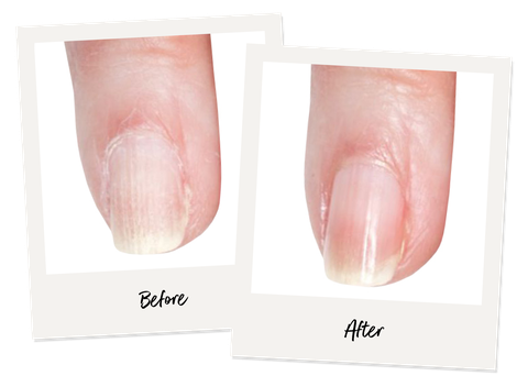 brittle vs healthy nailbed